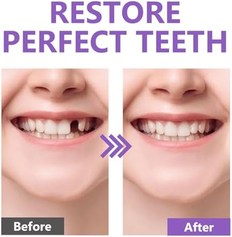 Tooth Repair Kit-for Broken Teeth, Moldable False Teeth-Filling Repair Kit, Fake Teeth DIY at Home, Fixing Missing & Broken Tooth Replacements, with 4 Dental Tools