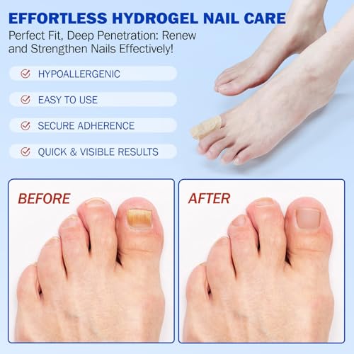 Toenail Fungus Treatment Extra Strength Nighttime Renewal Fungal Nail Patches - 21 Patch - Overnight Repair for Nail Fungus Damage, 8-Hour Treatment Restores Healthy Appearance (21 Count (Pack of 3))