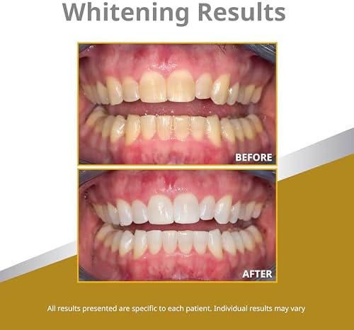 Opalescence 45% Syringes Teeth Whitening Gel - with PF - (4 Syringes) Refill Kit Carbamide Peroxide. Made by Ultradent, in Mint Flavor. Tooth Whitening 5359-2