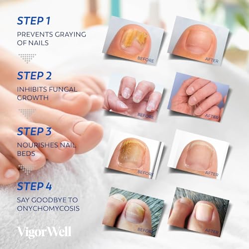 Toenail Fungus Treatment Extra Strength: (Small) 32 Patches with Hydrogel for Overnight Repair Fungus Nail Treatment For Toenail - Nighttime Nail Patches Visible Results in 8 Hours