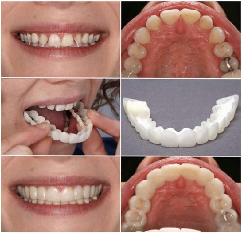 2 Pairs, Adjustable for Men and Women, Top and Bottom, Beautiful Smile
