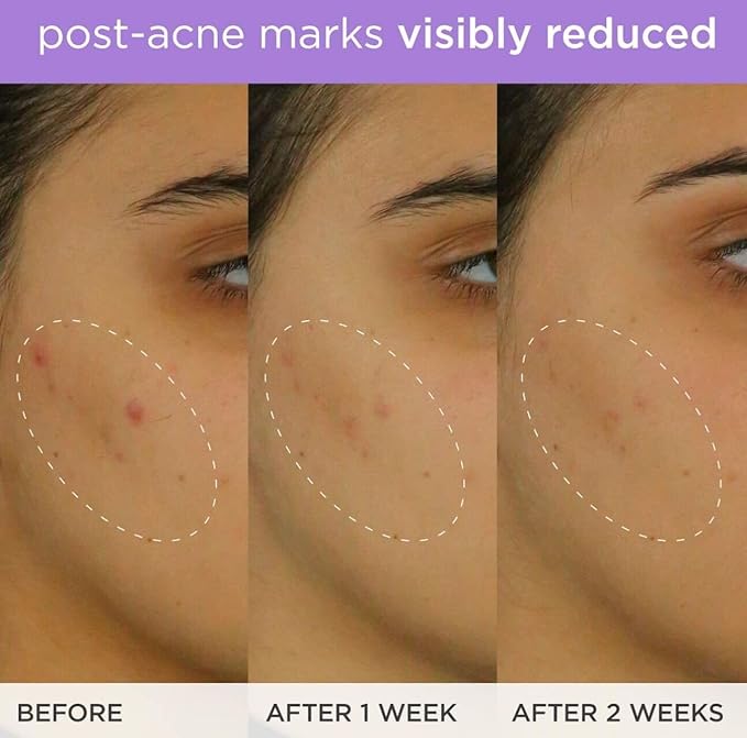 The Brightening Serum | Vitamin C Treatment for Brighter, Firmer Skin – Targets Hyperpigmentation & Fades Post-Acne Marks, 30 ml / 1.0 fl. oz.